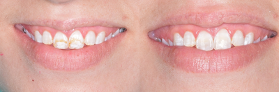 Teeth Whitening before and after photo
