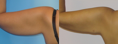 BodyTite before and after photo