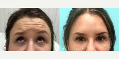 Botox before and after photo
