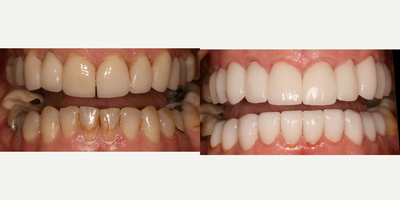 Dental Crown before and after photo