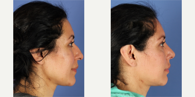 Rhinoplasty before and after photo