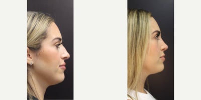 Rhinoplasty before and after photo