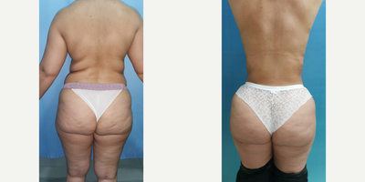 Brazilian Butt Lift before and after photo