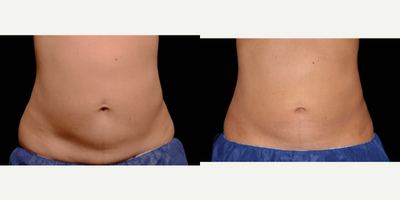 CoolSculpting before and after photo