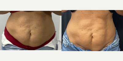 Emsculpt before and after photo