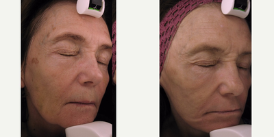 Fraxel Laser before and after photo