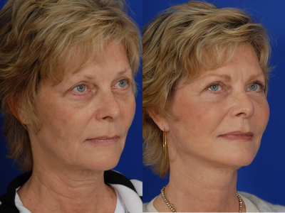 Mini Facelift before and after photo