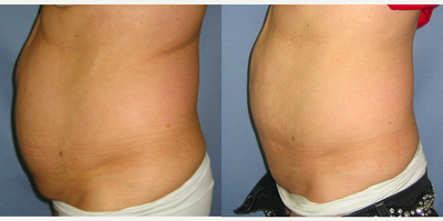SlimLipo before and after photo