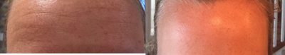 Botox before and after photo