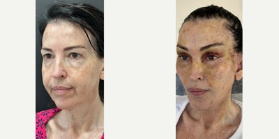 Deep Plane Facelift before and after photo