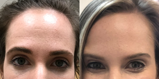 Dysport before and after photo