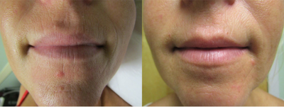 Forma before and after photo