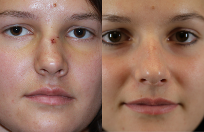Rhinoplasty before and after photo
