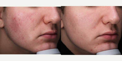 Vivace before and after photo