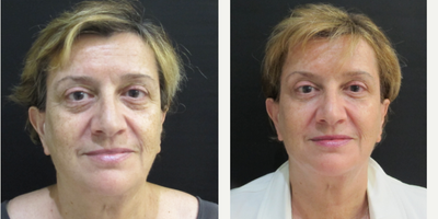 Botox before and after photo