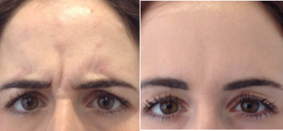Botox before and after photo