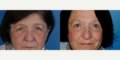 Brow Lift before and after photo