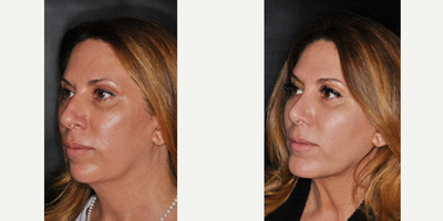 Chin Liposuction before and after photo