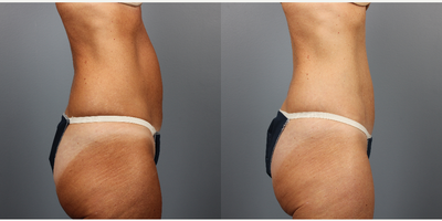 CoolSculpting before and after photo
