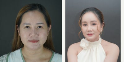 Eyelid Surgery before and after photo