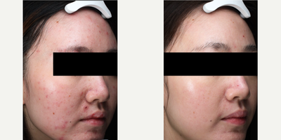 Laser Resurfacing before and after photo