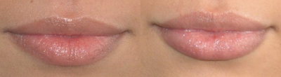 Lip Fillers before and after photo