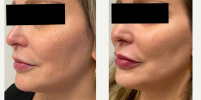 Restylane Contour before and after photo