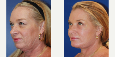 Facial Fat Transfer before and after photo