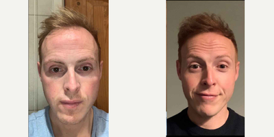 FUE Hair Transplant before and after photo