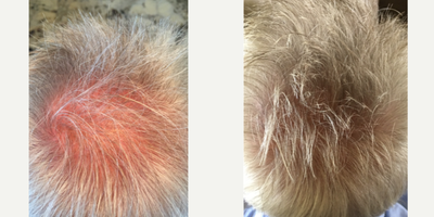 Hair Loss Treatment before and after photo
