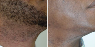 Laser Hair Removal before and after photo