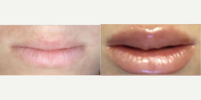 Lip Fillers before and after photo