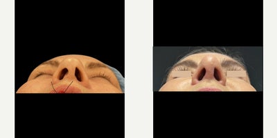 Rhinoplasty before and after photo