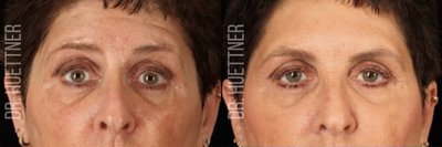 Botox before and after photo