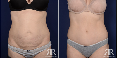 Body Lift before and after photo