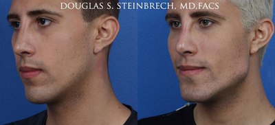 Botox before and after photo