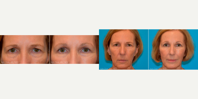 Brow Lift before and after photo