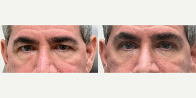 Brow Lift before and after photo