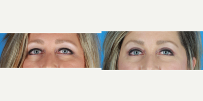 Eyelid Surgery before and after photo