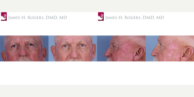 Eyelid Surgery before and after photo