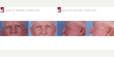 Eyelid Surgery before and after photo