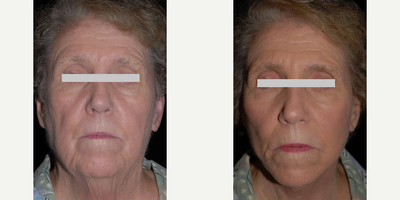 Facelift before and after photo