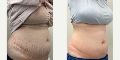 Halo Laser before and after photo
