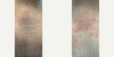 IPL before and after photo