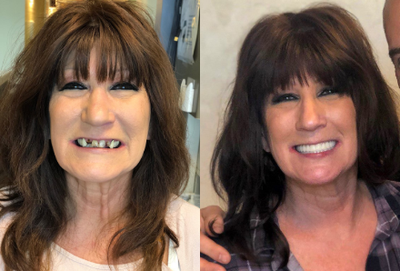 All-on-4 Dental Implants before and after photo