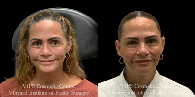 Botox before and after photo