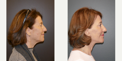 Facelift before and after photo