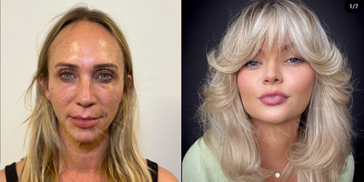 Facelift before and after photo