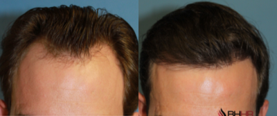 FUE Hair Transplant before and after photo