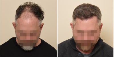 FUE Hair Transplant before and after photo